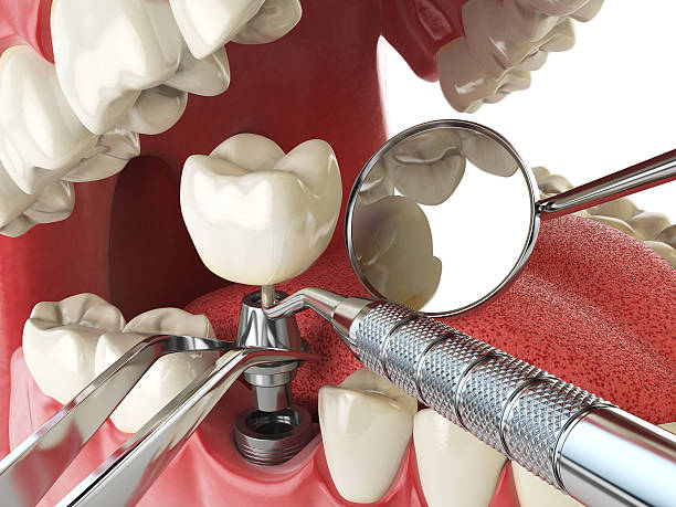 Best Chipped Tooth Repair Near Me  in Sawyerwood, OH